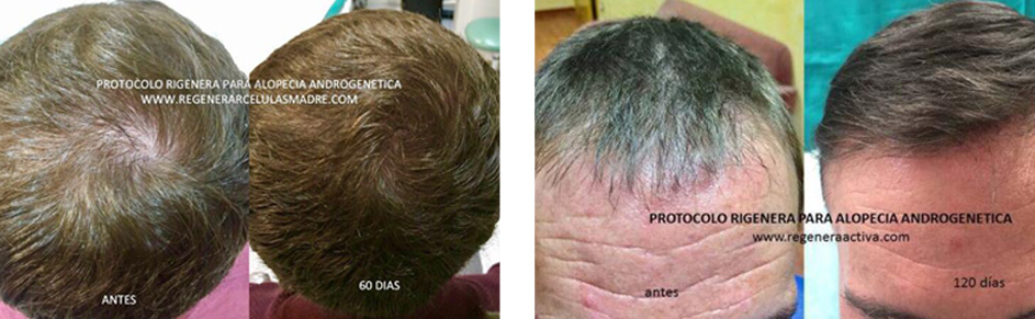 medicina rigenerativa capelli